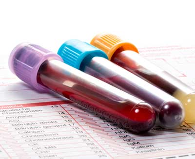 Blutproben – Blutuntersuchung bei Blähungen zur Diagnose